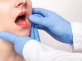 Раннее выявление и профилактика рака полости рта и глотки