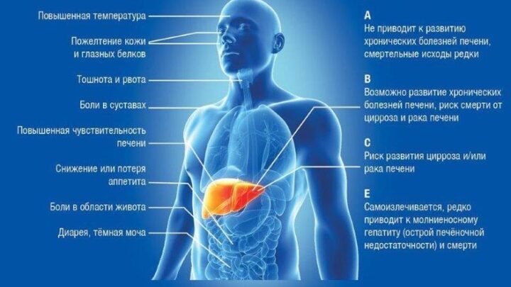 Вирусные гепатиты — должен знать каждый